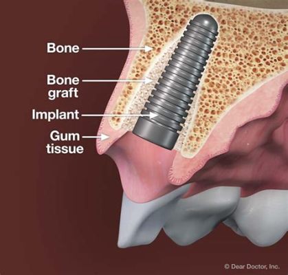 ¿Listón: Material Miracle para Implantes Óseos Avanzados?